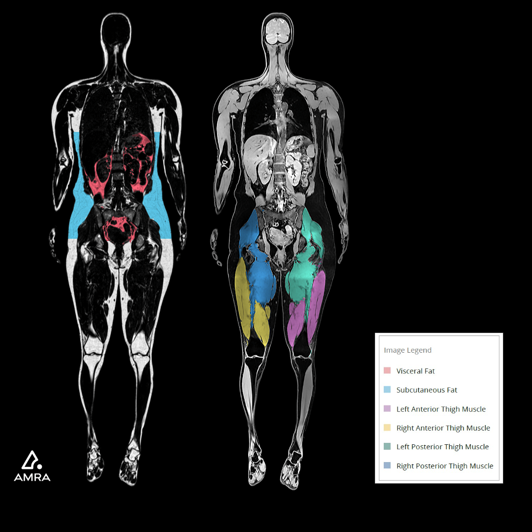 Current Offerings simonONE Preventative Annual Body MRI Scan